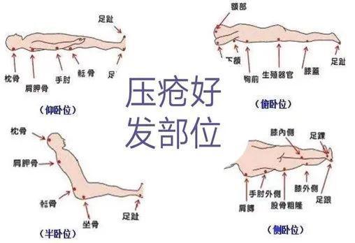 压疮的分期及临床表现最新版