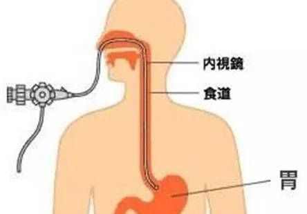 最新胃镜检查技术，不插管的价格及其优势分析